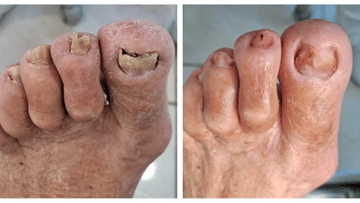 Pés antes e depois do tratamento de unhas